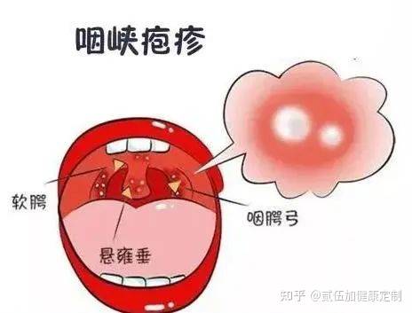 发什么言?疱疹性咽峡炎_口腔