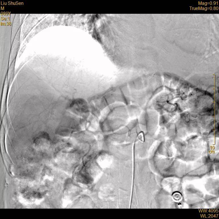 患者|高龄患者得肝癌就要放弃治疗？介入医生说“NO”！
