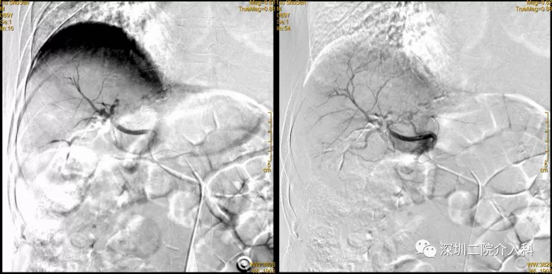 患者|高龄患者得肝癌就要放弃治疗？介入医生说“NO”！