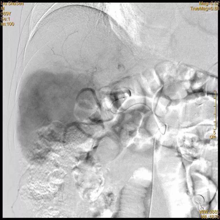 患者|高龄患者得肝癌就要放弃治疗？介入医生说“NO”！
