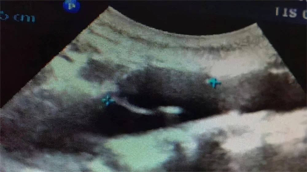 夹层|真性动脉瘤、假性动脉瘤、夹层动脉瘤特点及表现