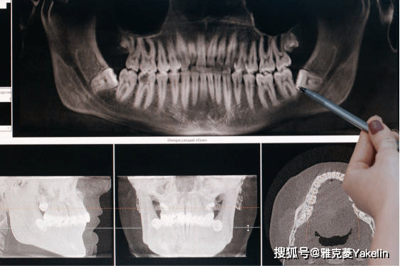 顳下頜關節紊亂⑥要保證正畸效果需要拔掉智齒⑤引起牙源性囊腫或腫瘤