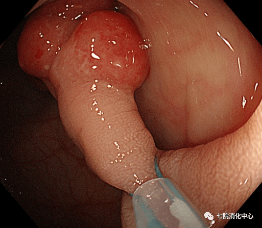 手术|结肠息肉怎么破？内镜帮您来搞定