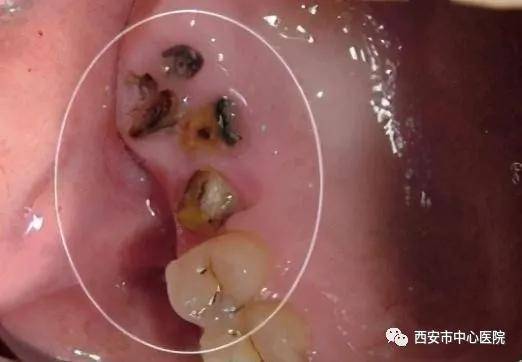 影响|有一种爱叫做放手 有一些牙你想留也留不住