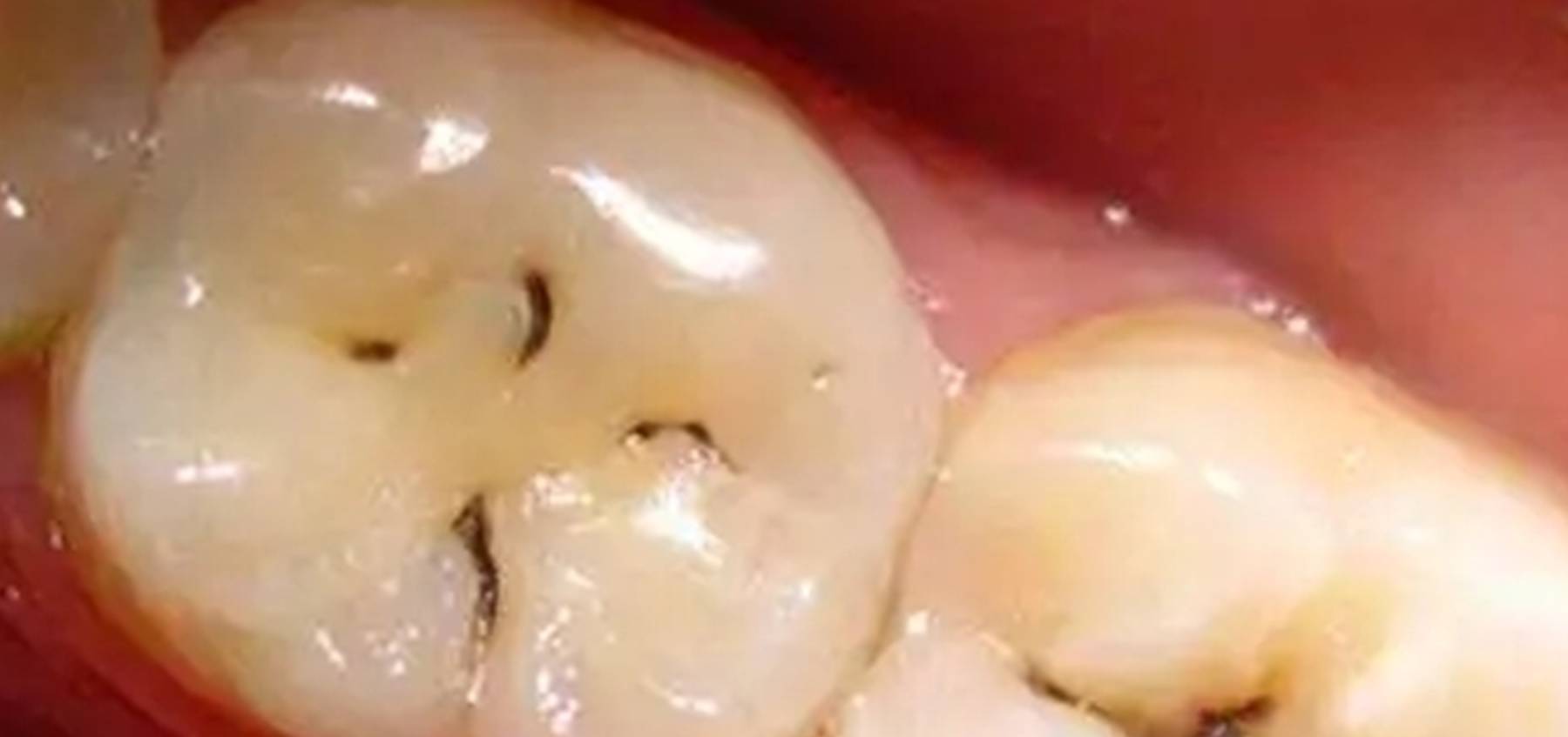 梦之谜，六齿落地，手接希望——解析梦见牙齿脱落的深层含义