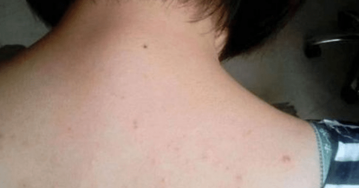 皮肤是hpv信号灯若皮肤出现2个异常建议尽早做筛查