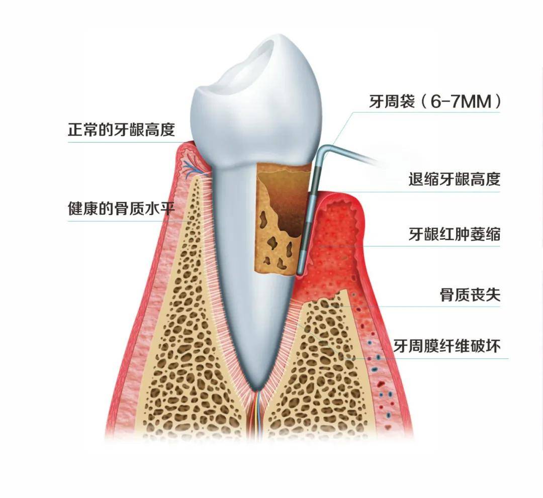 牙周病是指发生在牙周组织(牙龈,牙周膜,牙骨质和牙槽骨)的疾病