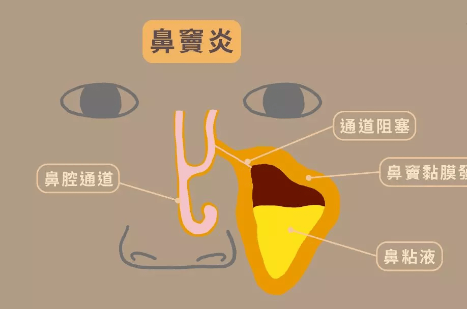 清鼻堂科普:鼻窦炎是影响青少年智力的第一大病