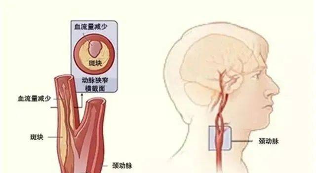心脑血管|动脉硬化危害大吗?什么情况下要吃药?应如何防治?这里全讲全了!