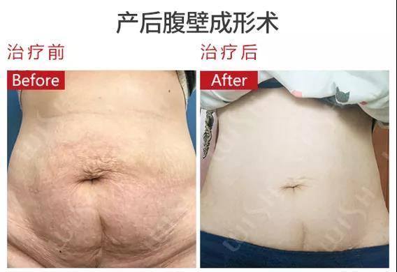 综合|上海正璞樊华院长凭借《剖宫产手术切口瘢痕的综合治疗》获奖