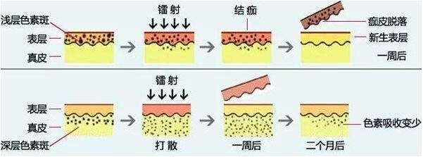 效果|激光祛斑好不好,激光祛斑后会反弹吗？