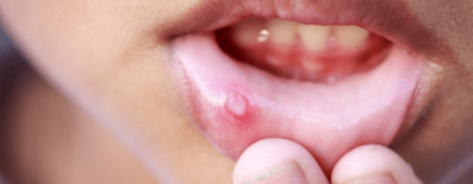 食物|容易上火 爱吃辣只是原因之一