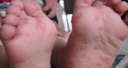 浆液|脚上出现这4个症状,说明你已经惹上糖尿病了,务必提高警惕!