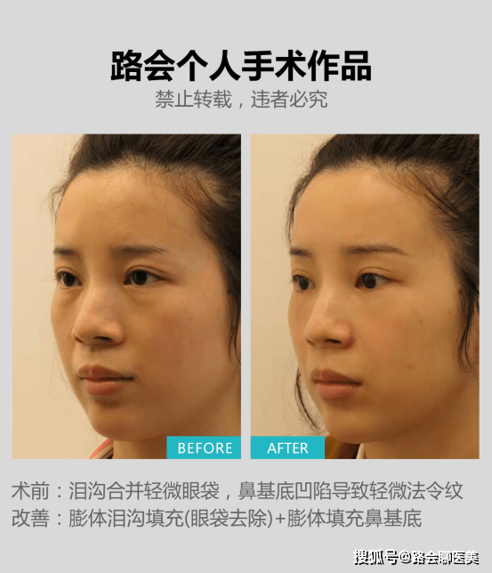 整形|听说膨体垫鼻基底后一辈子不能笑，这是真的吗？