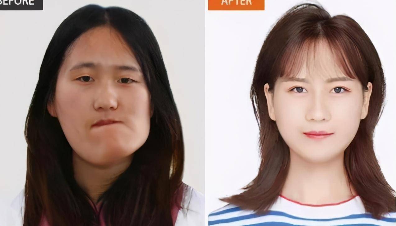 治疗|“歪脸女孩”赵宏秋：舍百万年薪当老师，网友：这才是整容的意义