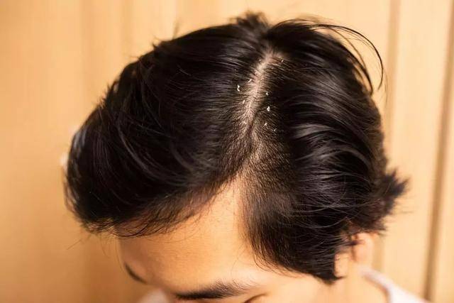 因为|山东一男子坚持用“硫磺皂水”洗头，3个月后，出现了什么变化