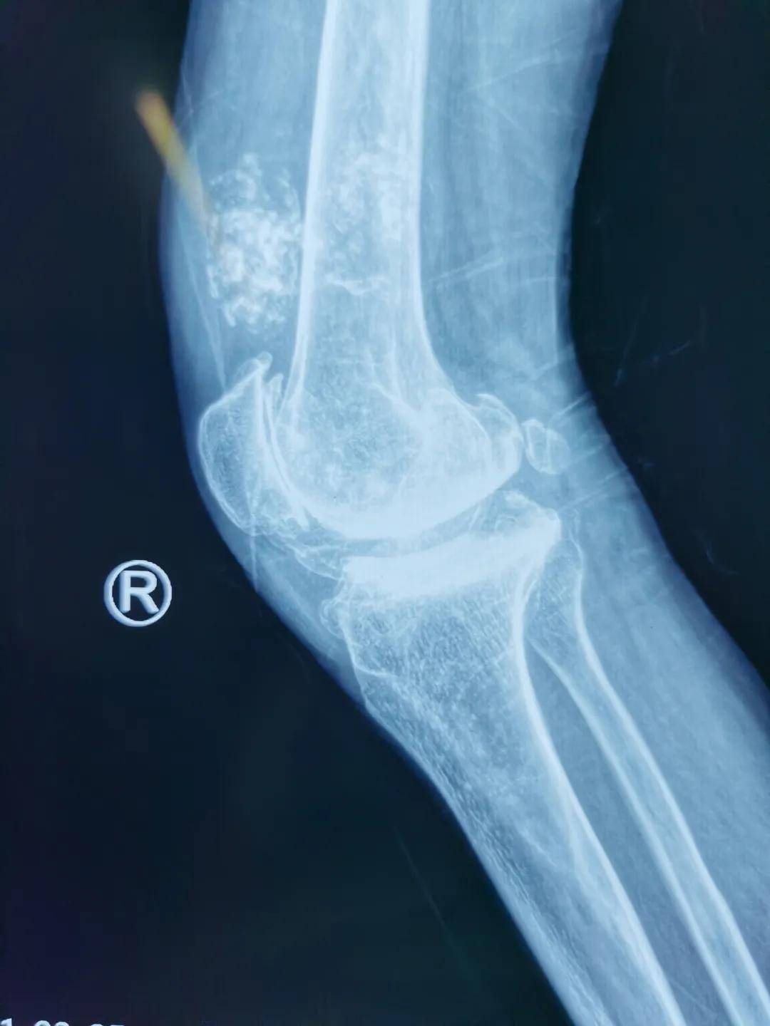 手术|西安市红会医院阎良院区双膝关节置换术圆了甘肃患者“行走梦”