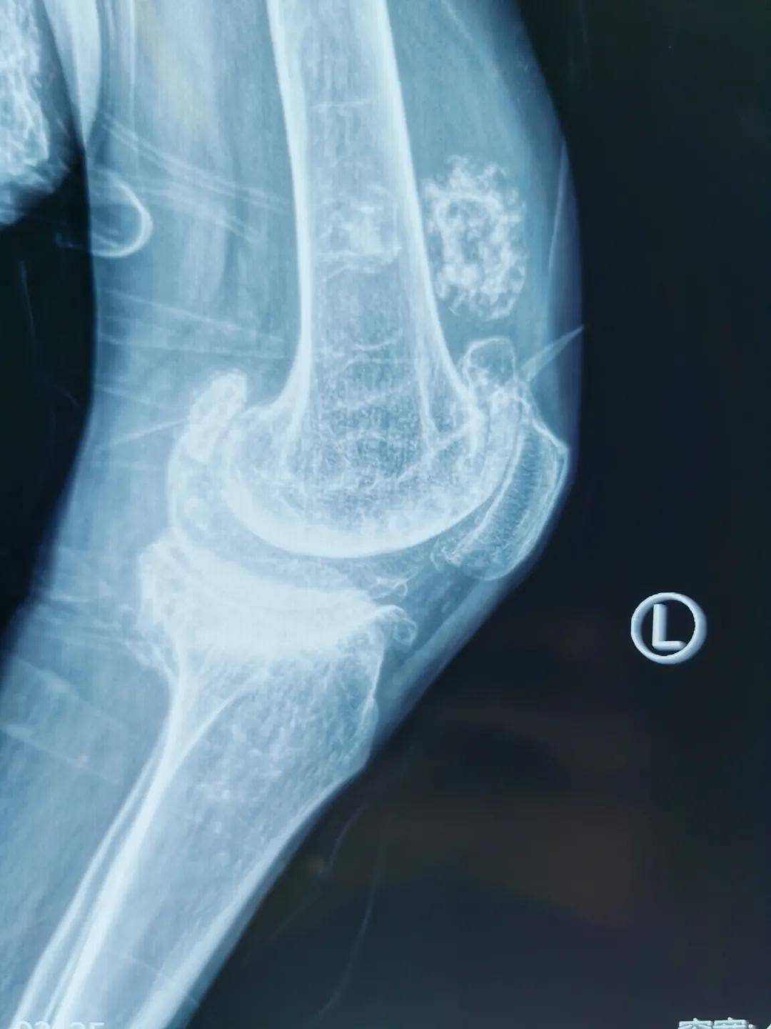 手术|西安市红会医院阎良院区双膝关节置换术圆了甘肃患者“行走梦”