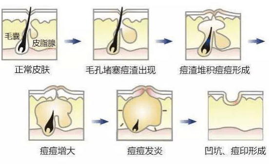 方法|痘痘反复、痘印难消 积雪苷霜软膏：那是你用错了方法