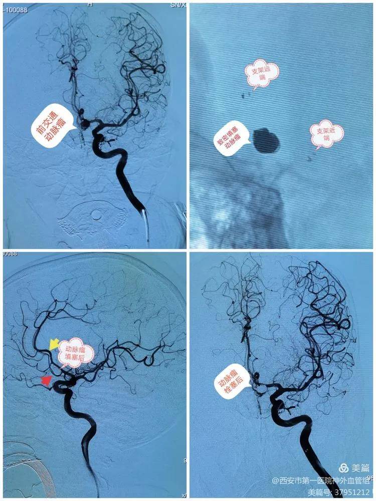 头颅|【医院动态】西安一院神外血管组介入病例系列15——7月“拆弹”“修路”记