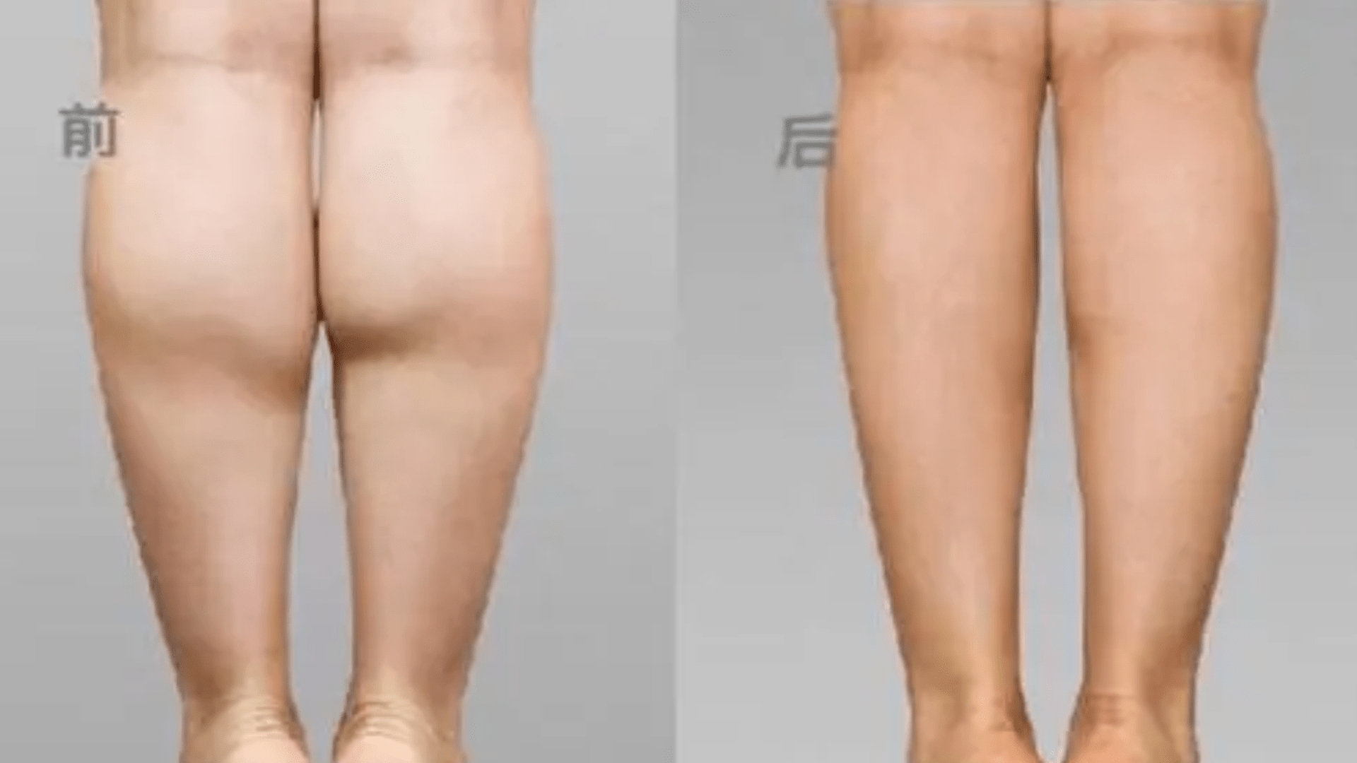 爱美|这种瘦身手术不能做，禁止小腿神经离断瘦腿，爱美人士要注意
