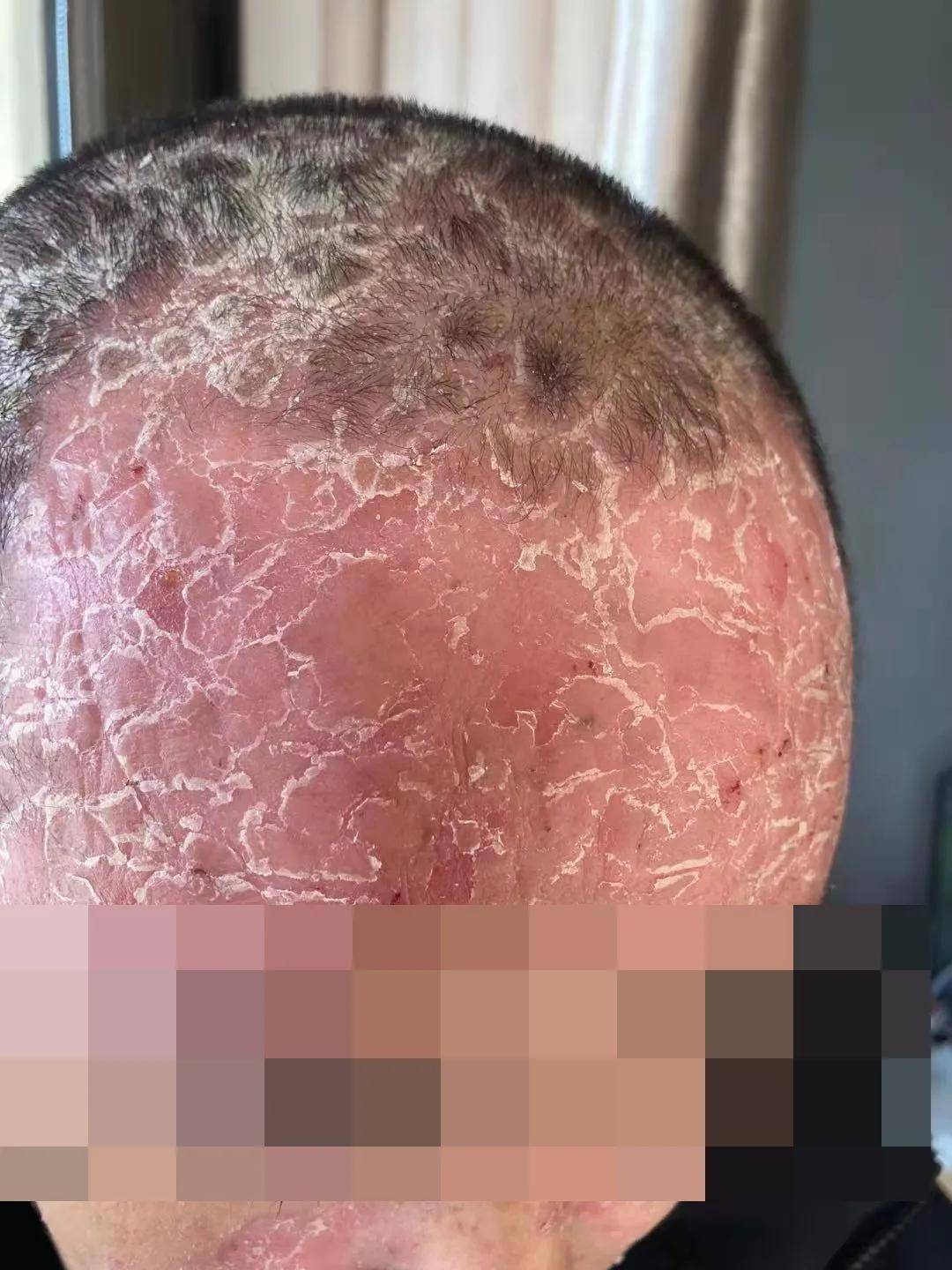 李文思医师治反复难愈的牛皮癣肤质焕新