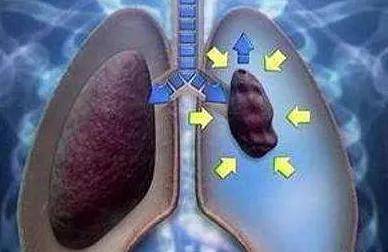 胸膜|“神探”内科胸腔镜