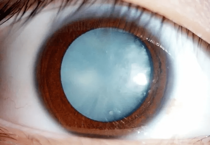 血糖|还在可乐饮料当水喝？当心喝出糖尿病性白内障