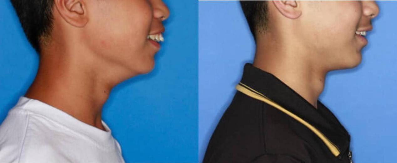 龅牙|广东省全民爱牙行动 地包天需要正畸正颌联合治疗