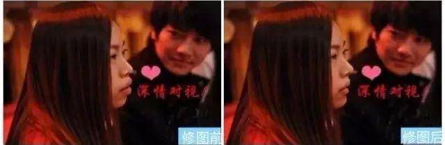 龅牙|广东省全民爱牙行动 地包天需要正畸正颌联合治疗