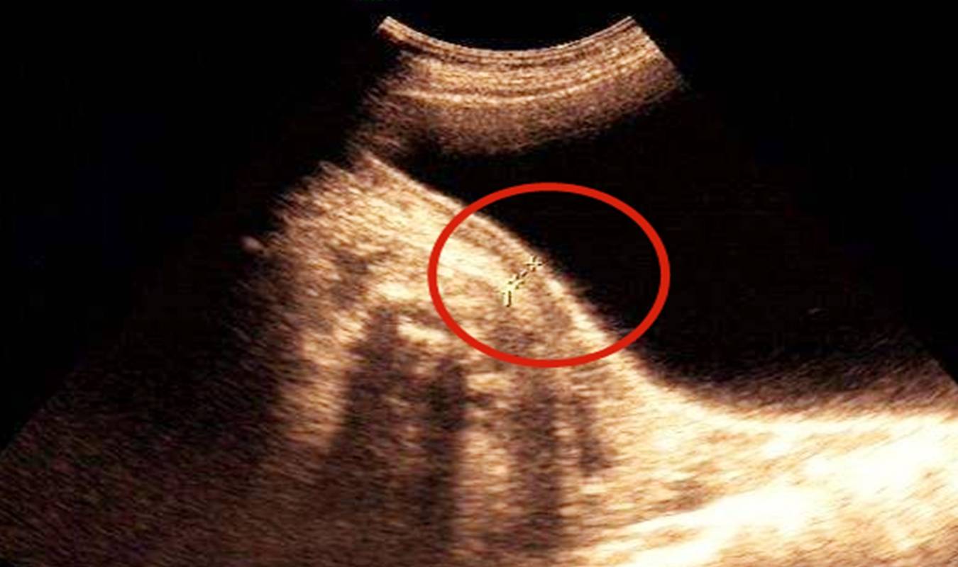 子宫|头胎剖宫产，二胎能否顺产分娩？须看这些指标，并非想顺就能顺