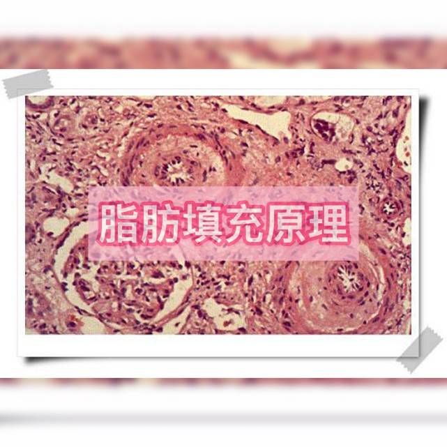 部位|脂肪填充10天就快没了？白做了？我的脸还有救吗