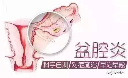 【养身元】我该拿你怎么办？盆腔炎。