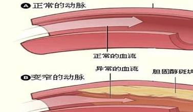 低密度胆固醇和高密度胆固醇过高 6bd9041616b64801ac31b77c8528041c.jpeg
