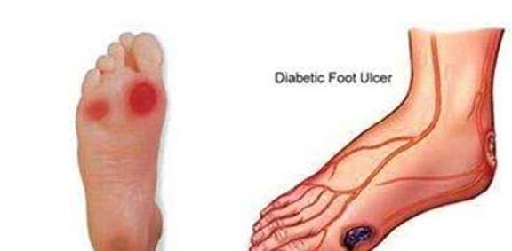 症状|血糖高的还有这些早期症状，没几个人知道