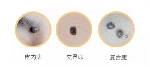 人员|西安国际医学中心整形医院色素痣诊疗中心杨国辉丨关注痣的变化