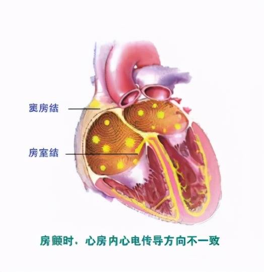 成功率|【一“心”只为您“健”康】有一种颤动，它的并发症竟然是脑卒中！