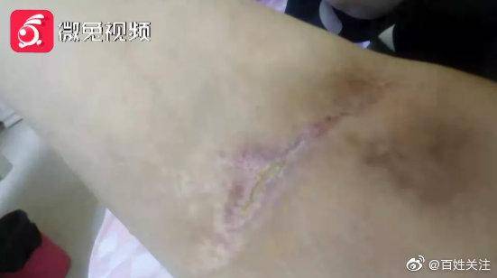 女子|贵阳女子抽脂后皮肤大面积坏死 院方：暂不考虑赔偿