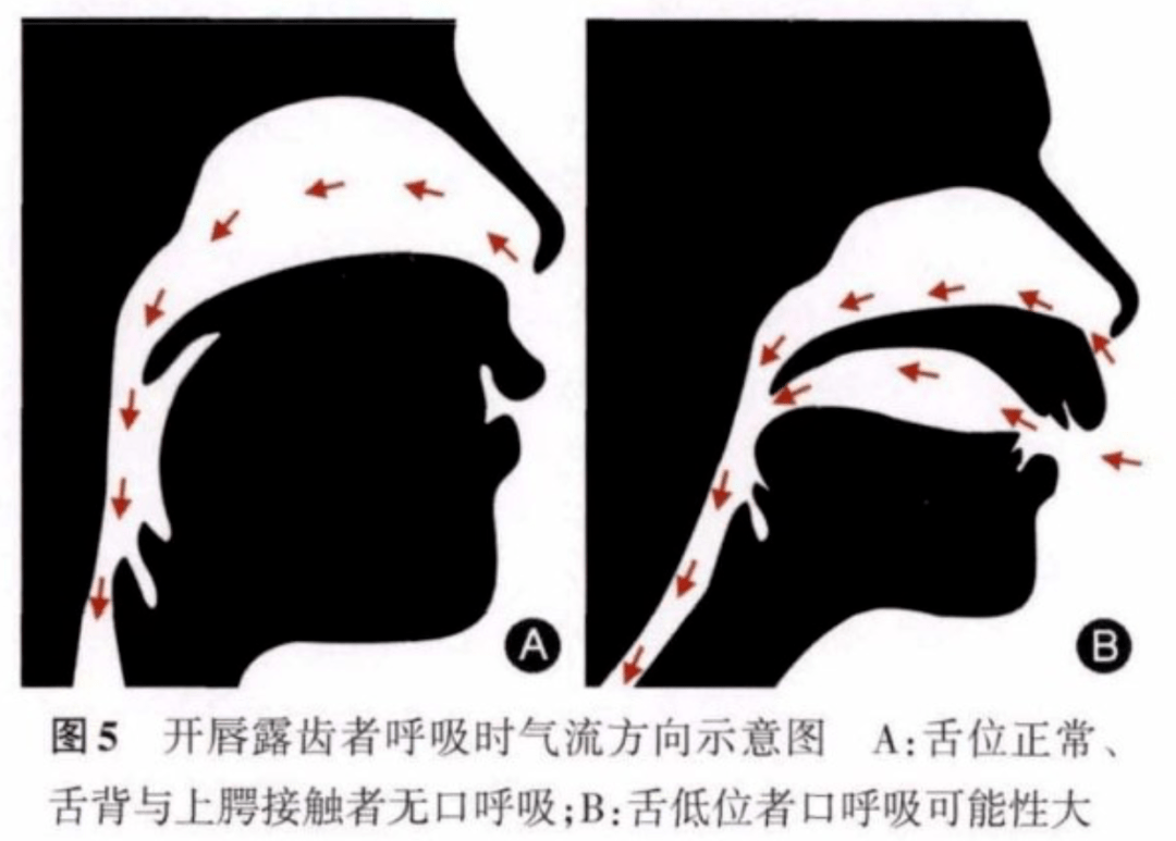 因为有的孩子虽然张着嘴巴呼吸,但舌头抵在上颚,气流基本不会从口腔