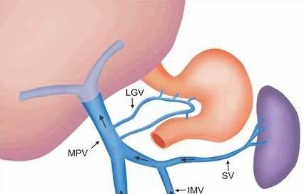 血液|体检出脾肿大,说明有肝硬化?慢性乙肝患者:欲知原因,请看此文