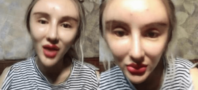 因为|女网红注射奥美定8年后爆发问题，额头内部溃烂，透露胸和屁股都曾注射奥美定