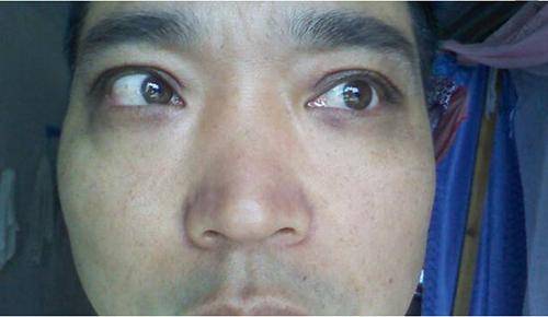 进行|肝脏求救信号之“手掌篇”,肝掌是什么?并发症有哪些?