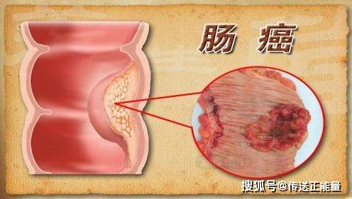 大腸息肉的