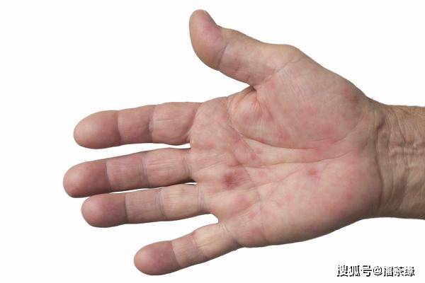 食欲|肝硬化患者，身体出现4个“变化”，肝硬化或在慢慢好转