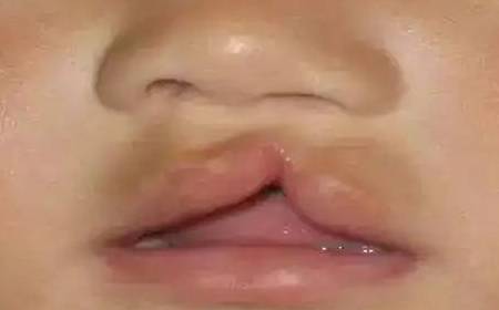 因为|孕妈生下兔唇儿，婆婆怪怀孕时吃了兔子肉，医生：兔子很委屈