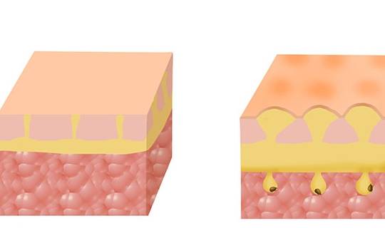 水液|查出尿毒症的人，不断增多，与什么有关？尿毒症早期，有何表现？