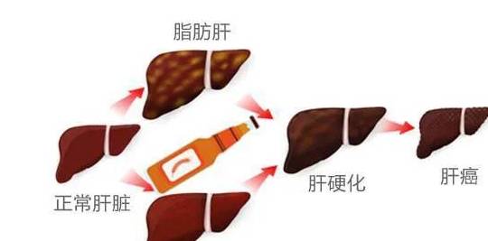乙醇|有位网友问：一个月两瓶啤酒，对肝脏有多大伤害？看医生如何回答
