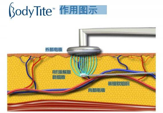 人群|黄金微雕、酷塑、美修斯、威塑 | 谁是下一个塑形之王？