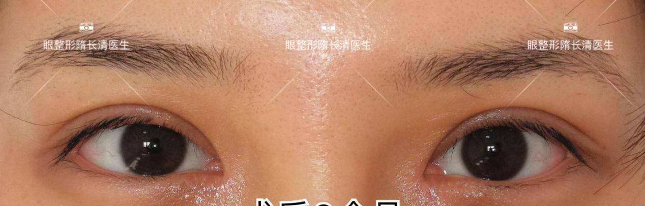 面的|她跟戚薇一样,做完双眼皮修复都变美了!