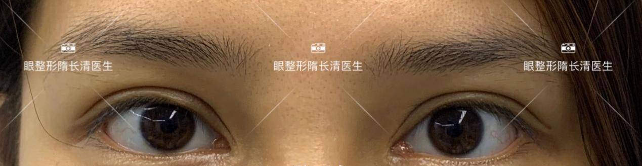 面的|她跟戚薇一样,做完双眼皮修复都变美了!